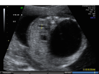 Hydronephrosis unilateral severe axial